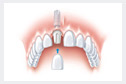 Das eingesetzte Implantat mit der neuen Zahnkrone